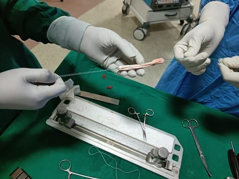 Surgical team preparing implant sizing instruments during orthopedic surgery at Osteon Orthopedic Hospital