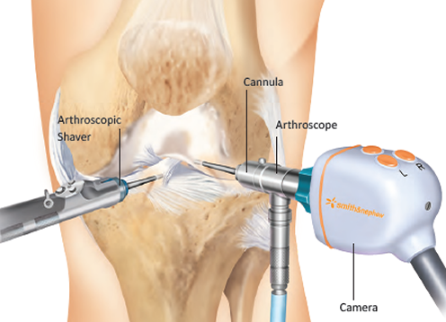 Arthroscopic knee surgery at Osteon Orthopedic Hospital, Pimple Saudagar