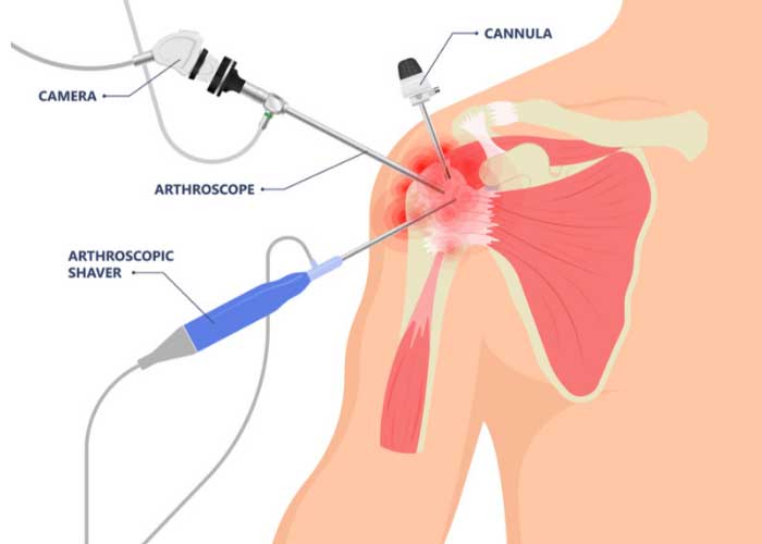 Arthroscopic Shoulder Surgery Hospital, Pimple Saudagar