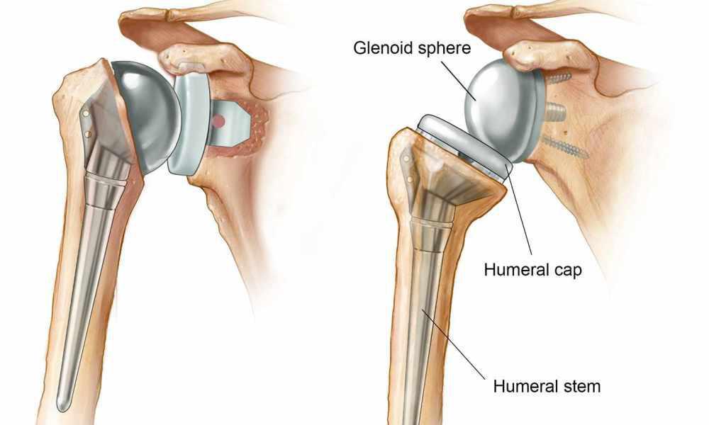 Shoulder surgery and shoulder replacement at Osteon Orthopedic Hospital, Pimple Saudagar