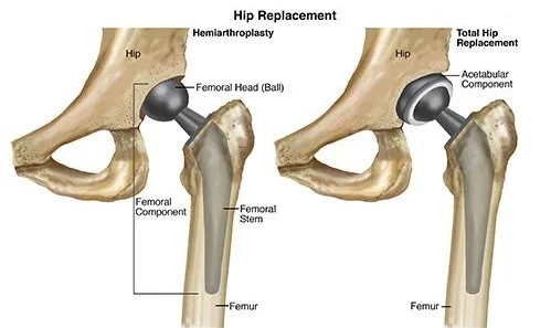 Total Hip Replacement Hospital, Pimple Saudagar