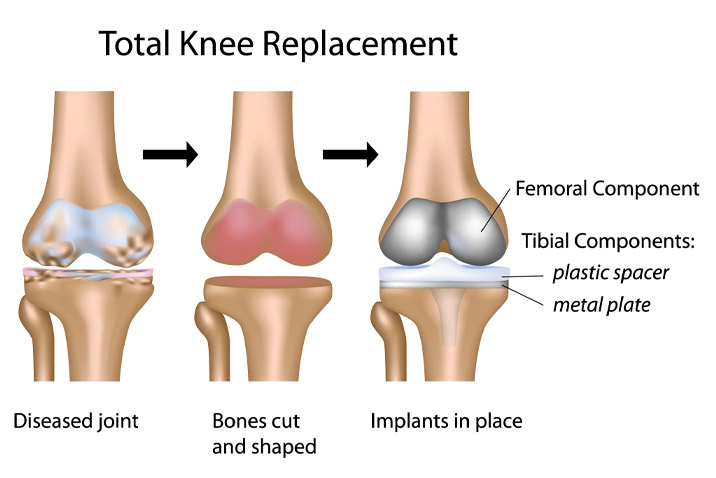 Robotic Total Knee Replacement at Osteon Orthopedic Hospital, Pimple Saudagar